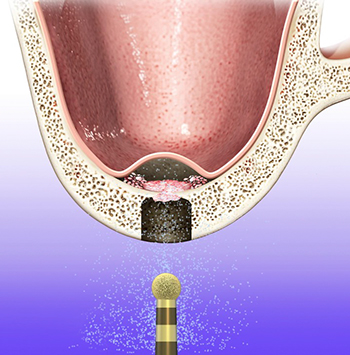 Operatie parodontoza laser